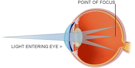 astigmatism