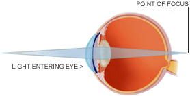 long-sightedness