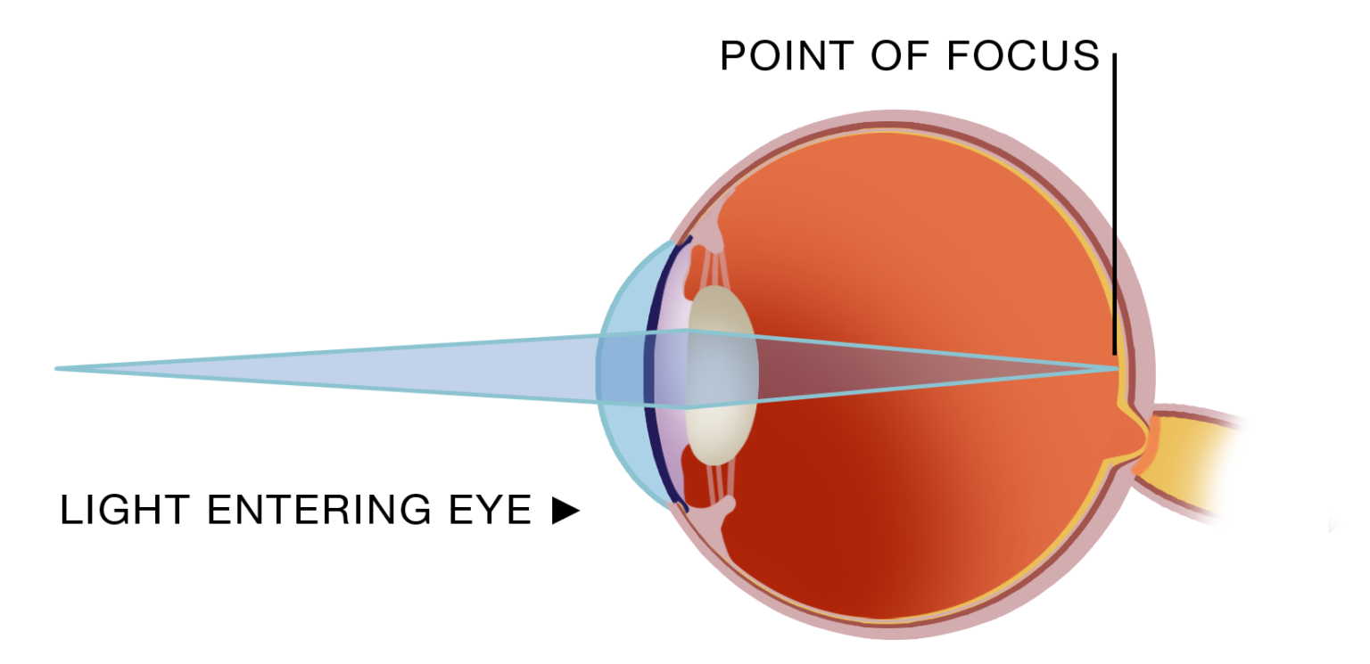 Eye Conditions & Refractive Errors Info VISTA EYES Clinic